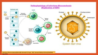 infectious Mononucleosis(Mono)By Kenneth M. Kaye , MD, Harvard Medical School| Modified
Sep 2022
 