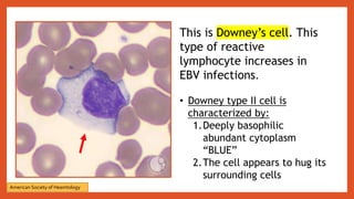 This is Downey’s cell. This
type of reactive
lymphocyte increases in
EBV infections.
• Downey type II cell is
characterized by:
1.Deeply basophilic
abundant cytoplasm
“BLUE”
2.The cell appears to hug its
surrounding cells
American Society of Heamtology
 