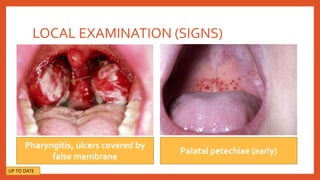 LOCAL EXAMINATION (SIGNS)
Pharyngitis, ulcers covered by
false membrane
Palatal petechiae (early)
UP TO DATE
 