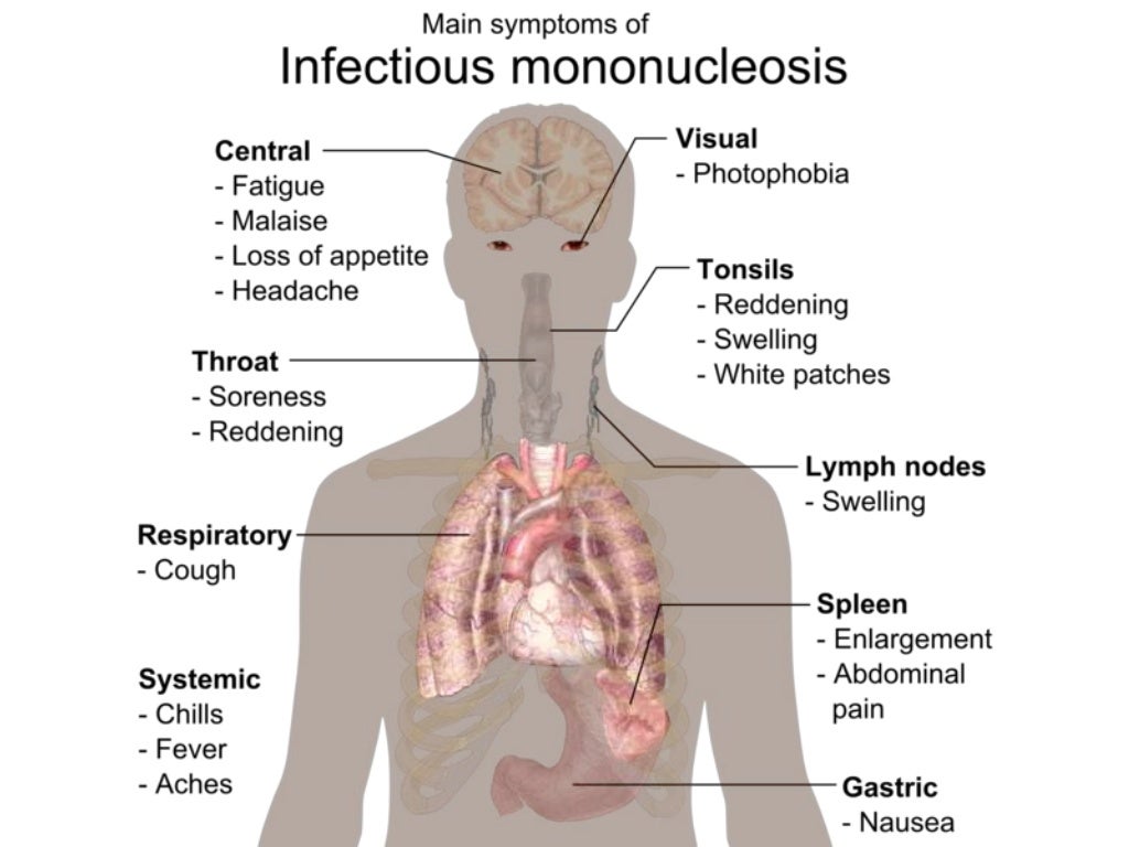 Infectious Mononucleosis Pathology