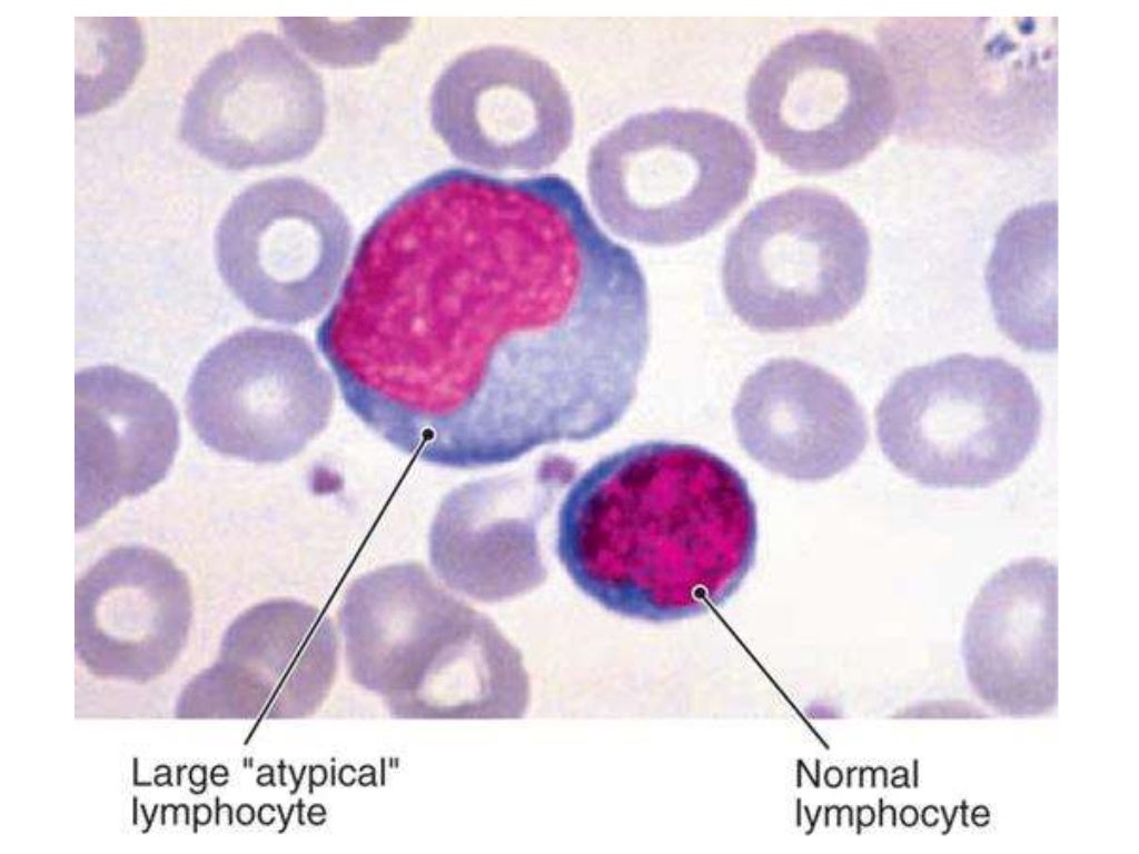 Реактивные лимфоциты в крови