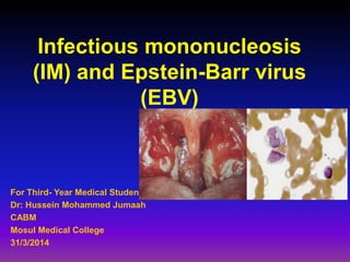 Infectious mononucleosis
(IM) and Epstein-Barr virus
(EBV)
For Third- Year Medical Students
Dr: Hussein Mohammed Jumaah
CABM
Mosul Medical College
31/3/2014
 
