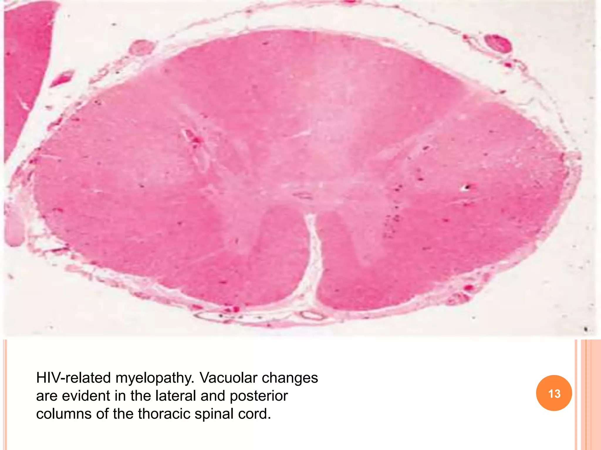 13
HIV-related myelopathy. Vacuolar changes
are evident in the lateral and posterior
columns of the thoracic spinal cord.
 