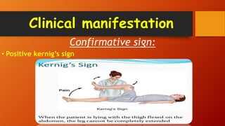 Clinical manifestation
Confirmative sign:
• Positive kernig’s sign
 