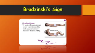 Brudzinski’s Sign
 