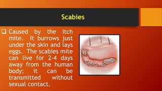 Scabies
 Caused by the itch
mite. It burrows just
under the skin and lays
eggs. The scabies mite
can live for 2-4 days
away from the human
body; it can be
transmitted without
sexual contact.
 