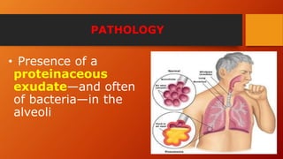 PATHOLOGY
• Presence of a
proteinaceous
exudate—and often
of bacteria—in the
alveoli
 