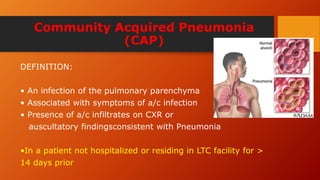 Community Acquired Pneumonia
(CAP)
DEFINITION:
• An infection of the pulmonary parenchyma
• Associated with symptoms of a/c infection
• Presence of a/c infiltrates on CXR or
auscultatory findingsconsistent with Pneumonia
•In a patient not hospitalized or residing in LTC facility for >
14 days prior
 