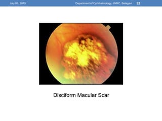 Disciform Macula Infectious uveitis | PPTX