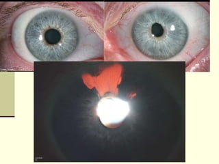 Infectious uveitis dr martinez (1) | PPT
