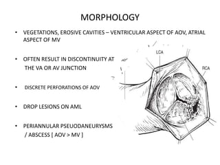 MORPHOLOGY
• VEGETATIONS, EROSIVE CAVITIES – VENTRICULAR ASPECT OF AOV, ATRIAL
ASPECT OF MV
• OFTEN RESULT IN DISCONTINUITY AT
THE VA OR AV JUNCTION
• DISCRETE PERFORATIONS OF AOV
• DROP LESIONS ON AML
• PERIANNULAR PSEUODANEURYSMS
/ ABSCESS [ AOV > MV ]
 