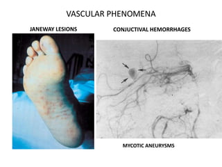 VASCULAR PHENOMENA
JANEWAY LESIONS CONJUCTIVAL HEMORRHAGES
MYCOTIC ANEURYSMS
 