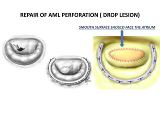 REPAIR OF AML PERFORATION ( DROP LESION)
SMOOTH SURFACE SHOULD FACE THE ATRIUM
 