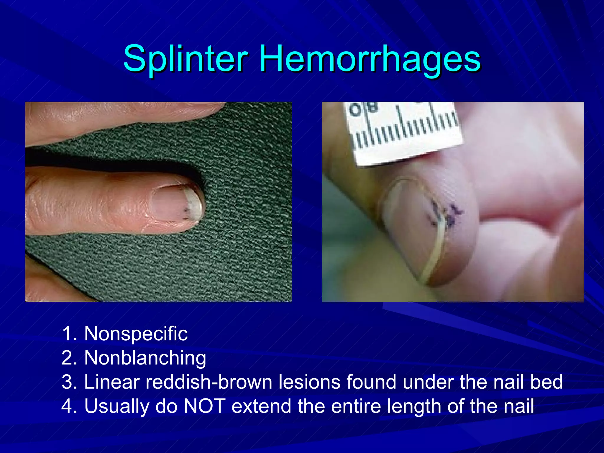 Infective endocarditis | PPT