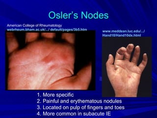 Osler’s Nodes
American College of Rheumatology
webrheum.bham.ac.uk/.../ default/pages/3b5.htm   www.meddean.luc.edu/.../
                                                 Hand10/Hand10dx.html




                 1. More specific
                 2. Painful and erythematous nodules
                 3. Located on pulp of fingers and toes
                 4. More common in subacute IE
 