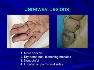 Janeway Lesions




1. More specific
2. Erythematous, blanching macules
3. Nonpainful
4. Located on palms and soles
 