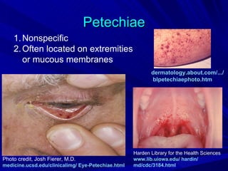 Petechiae
    1. Nonspecific
    2. Often located on extremities
       or mucous membranes
                                                           dermatology.about.com/.../
                                                           blpetechiaephoto.htm




                                                    Harden Library for the Health Sciences
Photo credit, Josh Fierer, M.D.                     www.lib.uiowa.edu/ hardin/
medicine.ucsd.edu/clinicalimg/ Eye-Petechiae.html   md/cdc/3184.html
 