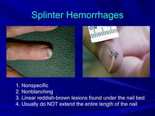 Splinter Hemorrhages




1. Nonspecific
2. Nonblanching
3. Linear reddish-brown lesions found under the nail bed
4. Usually do NOT extend the entire length of the nail
 