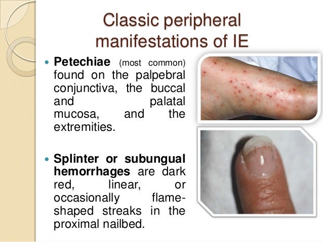 Infective Endocarditis Causes Signs Symptoms Infective Endocarditis