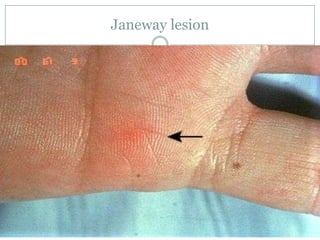 Janeway lesion
 