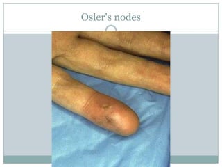 Osler's nodes
 