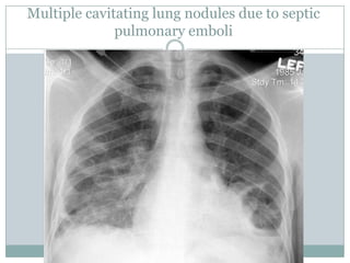 Multiple cavitating lung nodules due to septic
pulmonary emboli
 