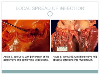 LOCAL SPREAD OF INFECTION
Acute S. aureus IE with perforation of the
aortic valve and aortic valve vegetations.
Acute S. aureus IE with mitral valve ring
abscess extending into myocardium.
 