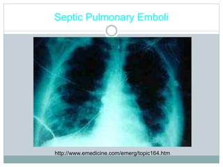 Septic Pulmonary Emboli
http://www.emedicine.com/emerg/topic164.htm
 