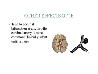 OTHER EFFECTS OF IE
 Tend to occur at
bifurcation areas; middle
cerebral artery is most
common,Clinically silent
until rupture
 