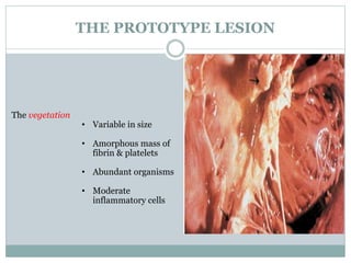 THE PROTOTYPE LESION
The vegetation
• Variable in size
• Amorphous mass of
fibrin & platelets
• Abundant organisms
• Moderate
inflammatory cells
 