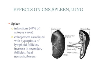 EFFECTS ON CNS,SPLEEN,LUNG
 Spleen
 infarctions (44% of
autopsy cases)
 enlargement associated
with hyperplasia of
lymphoid follicles,
increase in secondary
follicles, focal
necrosis,abscess
 