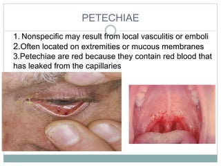 PETECHIAE
1. Nonspecific may result from local vasculitis or emboli
2.Often located on extremities or mucous membranes
3.Petechiae are red because they contain red blood that
has leaked from the capillaries
 