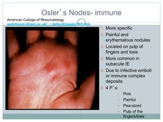 Osler’s Nodes- immune
American College of Rheumatology
webrheum.bham.ac.uk/.../ default/pages/3b5.htm
1. More specific
2. Painful and
erythematous nodules
3. Located on pulp of
fingers and toes
4. More common in
subacute IE
5. Due to infective emboli
or immune complex
deposits
6. 4 P’s:
 Pink
 Painful
 Pea-sized
 Pulp of the
fingers/toes
 