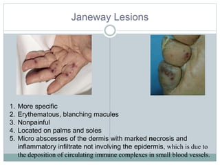 Janeway Lesions
1. More specific
2. Erythematous, blanching macules
3. Nonpainful
4. Located on palms and soles
5. Micro abscesses of the dermis with marked necrosis and
inflammatory infiltrate not involving the epidermis, which is due to
the deposition of circulating immune complexes in small blood vessels.
 