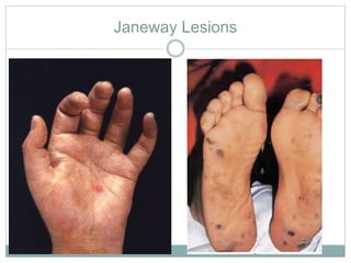 Janeway Lesions
 