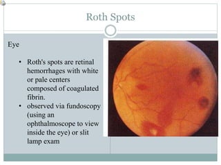 Roth Spots
Eye
• Roth's spots are retinal
hemorrhages with white
or pale centers
composed of coagulated
fibrin.
• observed via fundoscopy
(using an
ophthalmoscope to view
inside the eye) or slit
lamp exam
 