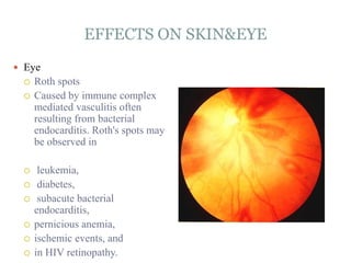 EFFECTS ON SKIN&EYE
 Eye
 Roth spots
 Caused by immune complex
mediated vasculitis often
resulting from bacterial
endocarditis. Roth's spots may
be observed in
 leukemia,
 diabetes,
 subacute bacterial
endocarditis,
 pernicious anemia,
 ischemic events, and
 in HIV retinopathy.
 