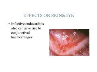 EFFECTS ON SKIN&EYE
 Infective endocarditis
also can give rise to
conjunctival
haemorrhages
 