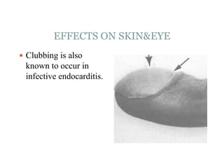 EFFECTS ON SKIN&EYE
 Clubbing is also
known to occur in
infective endocarditis.
 