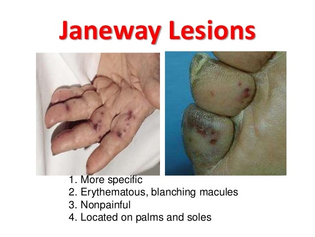 Infective endocarditis