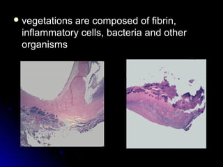  vegetations are composed of fibrin,vegetations are composed of fibrin,
inflammatory cells, bacteria and otherinflammatory cells, bacteria and other
organismsorganisms
 