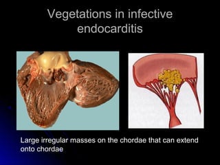 Vegetations in infectiveVegetations in infective
endocarditisendocarditis
Large irregular masses on the chordae that can extend
onto chordae
 