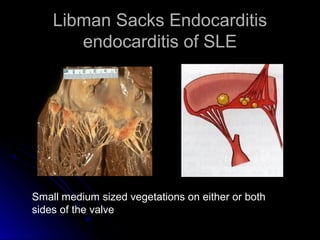 Libman Sacks EndocarditisLibman Sacks Endocarditis
endocarditis of SLEendocarditis of SLE
Small medium sized vegetations on either or both
sides of the valve
 