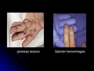Janeway lesions Splinter hemorrhages
 