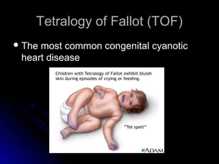 Tetralogy of Fallot (TOF)Tetralogy of Fallot (TOF)
 The most common congenital cyanoticThe most common congenital cyanotic
heart diseaseheart disease
 