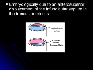 Embryologically due to an anterosuperiorEmbryologically due to an anterosuperior
displacement of the infundibular septum indisplacement of the infundibular septum in
the truncus arteriosusthe truncus arteriosus
 
