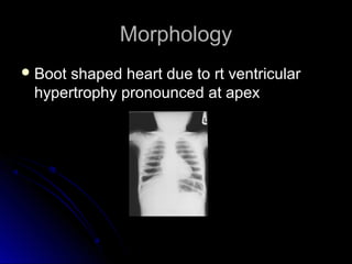 MorphologyMorphology
 Boot shaped heart due to rt ventricularBoot shaped heart due to rt ventricular
hypertrophy pronounced at apexhypertrophy pronounced at apex
 