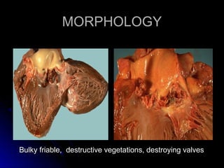 MORPHOLOGYMORPHOLOGY
Bulky friable, destructive vegetations, destroying valvesBulky friable, destructive vegetations, destroying valves
 