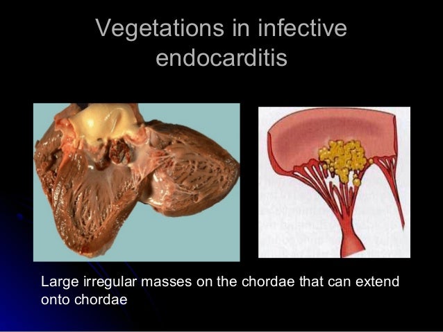 Infective endocarditis
