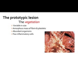 The prototypic lesion
The vegetation
Variable in size
Amorphous mass of fibrin & platelets
Abundant organisms
Few inflammatory cells
 